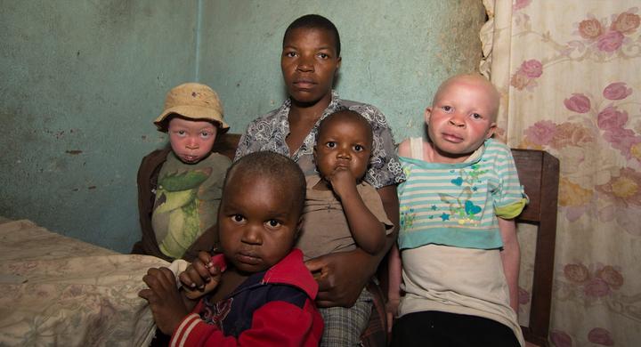 Malawi: Killing spree of people with albinism fuelled by policing failures